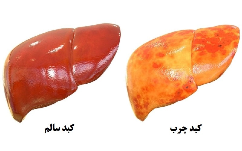 کبد چرب و راه های پیشگیری و درمان آن